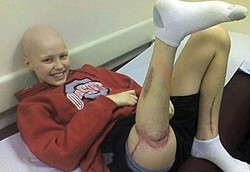 Operasi Kaki Radikal Akibat Kanker Agar Bisa Tetap Aktif