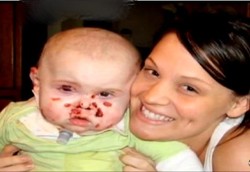 Kulit Balita Terus Melepuh Karena Penyakit Sayap Kupu-kupu