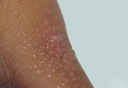 Lichen Nitidus, Benjolan Kecil Sewarna Kulit yang Langka