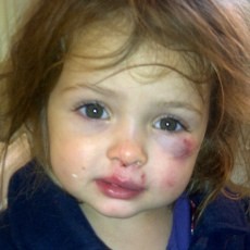 Ya Ampun! Bocah 3 Tahun Memar Dipukuli Balita Lain di Penitipan Anak