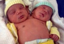 Seorang Ibu Lahirkan Bayi Berkepala 2 di Brazil