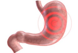 5 Cara Cepat Redakan Asam Lambung