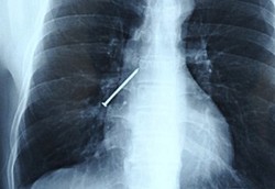 Mau Dikeluarkan Lewat Operasi, Paku Malah Tertelan Lagi 3 Kali