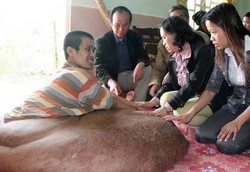 Tumor Raksasa Pria Vietnam akan Dioperasi, Peluang Sembuh 50%