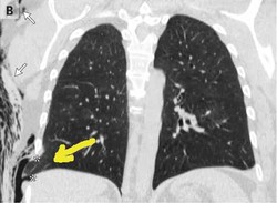Batuk Terlalu Keras, Paru-paru Geser Menembus Tulang Iga