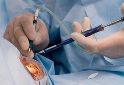 Kenapa Katarak yang Sudah Dioperasi Bisa Muncul Lagi?