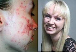 Dulu Diolok Karena Jerawatan, Kini Ikut Kontes Kecantikan