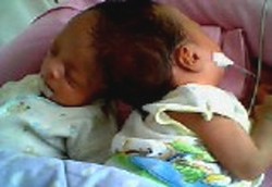 1 Bayi Kembar Dempet Kepala Meninggal Usai Dioperasi RSCM