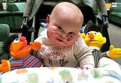 Meninggal Dipelukan sang Ibu Akibat Penyakit Kulit Langka