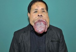 Mulut Tak Bisa Menutup 21 Tahun Akibat Tumor Lidah Raksasa