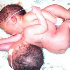 Bayi Perempuan Kembar Dempet Asal Riau Akan Dirujuk ke RSCM