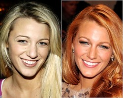 10 Selebriti Dunia yang Operasi Hidung