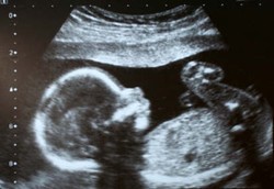 Duh! Aborsi Dianggap Lebih Aman dari Persalinan