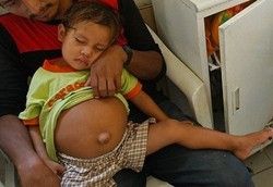 Balita yang Telan Saudara Kembarnya di Dalam Perut