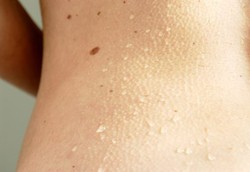 Banyak Tahi Lalat Bisa Perpanjang Umur