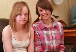 Kakak Adik Ganti Kulit Tiap Hari Karena Kulitnya Tumbuh Cepat