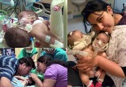 9 Operasi Pemisahan Bayi Kembar Siam Paling Dikenang