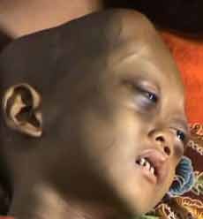 RSU Soetomo Siap Rawat Bocah Penderita Tumor Syaraf Mata Kediri