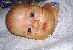 Akibat Salah Pasang Oksigen, Operasi Sulit si Bayi Jadi Sia-sia