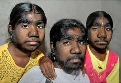 3 Bersaudara Takut Tak Bisa Menikah Akibat Sindrom Serigala