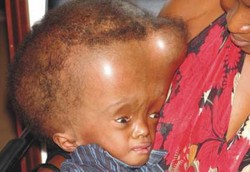 Mengapa Seorang Anak Bisa Menderita Hidrosefalus?