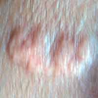 Daging Menyerupai Lafadz Allah di Kening Bayi, Dokter Anggap Keloid