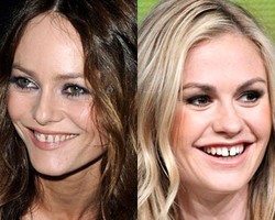 7 Selebriti yang Giginya Berantakan