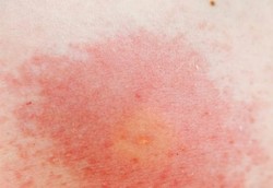 Morphea, Bercak Kemerahan atau Keunguan pada Kulit