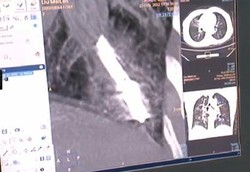 Termometer Terjebak Dalam Paru-paru Wanita Selama 44 Tahun