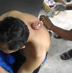 Rumah Sehat Layani Bekam Bagi Warga Miskin