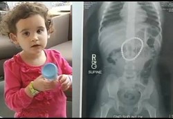 Usus Perut Bolong-bolong Karena Telan Mainan Magnet