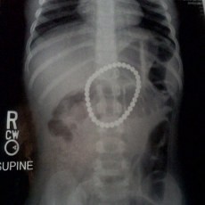 Aduh... Balita Telan 37 Magnet!