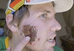 Wajah Tampan Jadi Mengerikan Karena Digerogoti Parasit