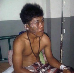 Mahasiswa yang Terbakar Saat Demo Alami Luka di Wajah