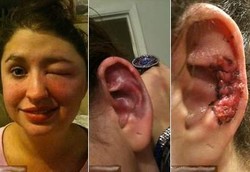 Efek Dahsyat Digigit Laba-laba: Telinga Busuk & Hampir Buta