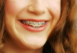 Kalau Cuma Aksesoris, Tukang Gigi Pasang Behel Tak Masalah