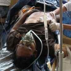 Terlindas Ekskavator Saat Tidur, Dua Kaki dan Tangan Pekerja Putus