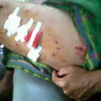 Bom Meledak di Tuban, Luka Korban Seperti Terkena Serpihan Paku