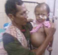 Balita 22 Bulan Berjuang Melawan Tumor Liver