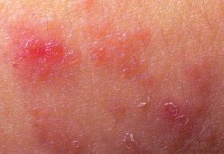 Tomcat Menyerang, Kulit Meradang