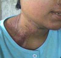 11 Warga Garut Jadi Korban Serangan Serangga Tomcat 