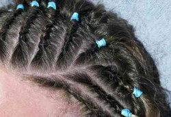 Kista Pilonidal, Kantong Berisi Rambut dan Kotoran di Kulit 