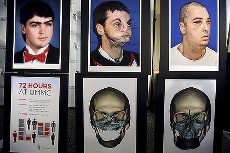 Setelah 15 Tahun Wajahnya Rusak, Pria AS Kini Punya Wajah Baru