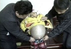 Remaja Berperut Buncit Seperti Hamil Karena Penyakit Hati