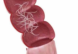 Ascariasis, Infeksi Karena Ratusan Cacing Gelang dalam Tubuh