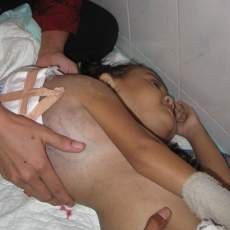 Bocah Penderita Benjolan Sebesar Bola Voli Akan Dirujuk ke RSU Dr Soetomo