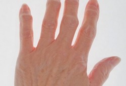 Ditemukan Virus yang Bisa Melawan Lupus