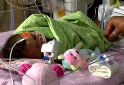 Bayi Berjuang Hidup Karena Lahir dengan Jantung Separuh