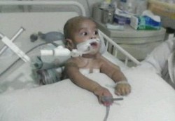 Seumur Hidup Pakai Ventilator, Bayi Kevin Akhirnya Meninggal