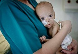 Bayi Ini Masih Bertahan Hidup Meski Ususnya Cuma 10 Cm